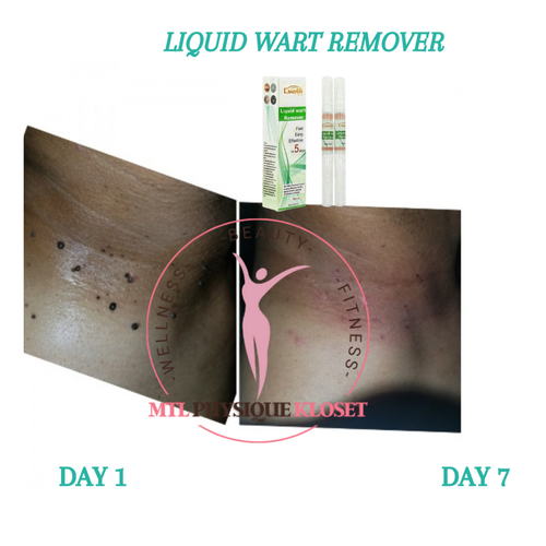 2-Pack Liquid Wart Remover Pens – Fast-Acting & Painless Treatment for Common, Plantar, and Genital Warts