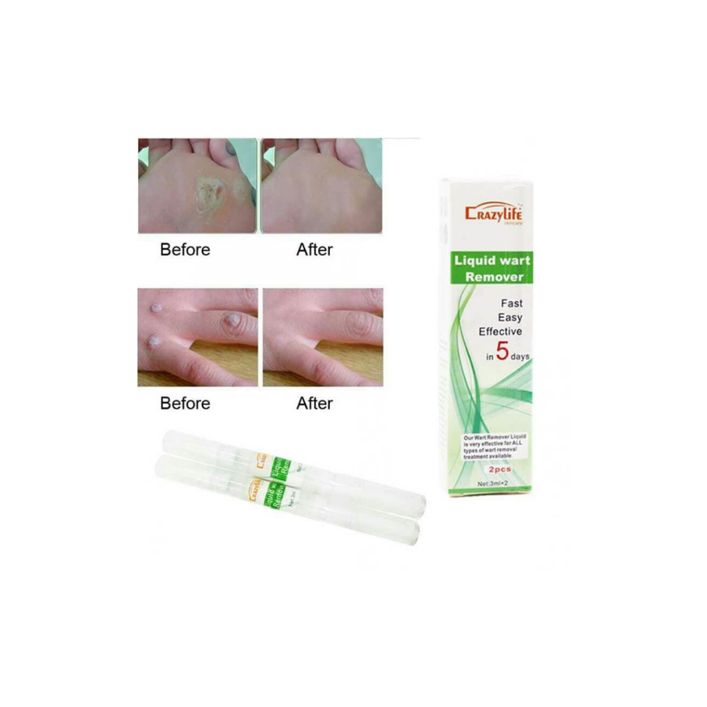 2-Pack Liquid Wart Remover Pens – Fast-Acting & Painless Treatment for Common, Plantar, and Genital Warts