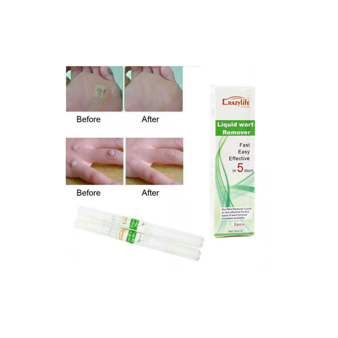 2-Pack Liquid Wart Remover Pens – Fast-Acting & Painless Treatment for Common, Plantar, and Genital Warts