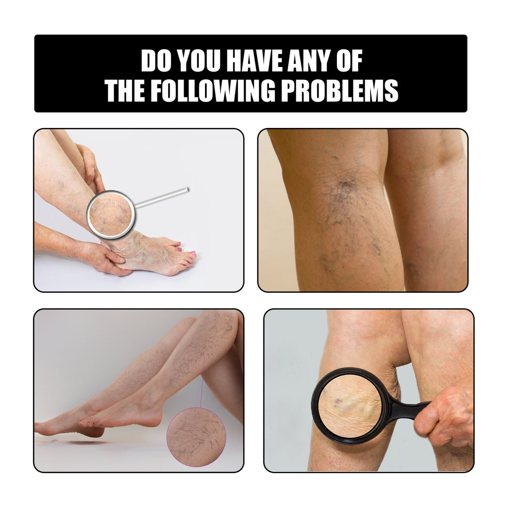 Vein Repair Patch To Relieve Pain And Swelling Earthworm Leg Blue Veins Repair Plaster