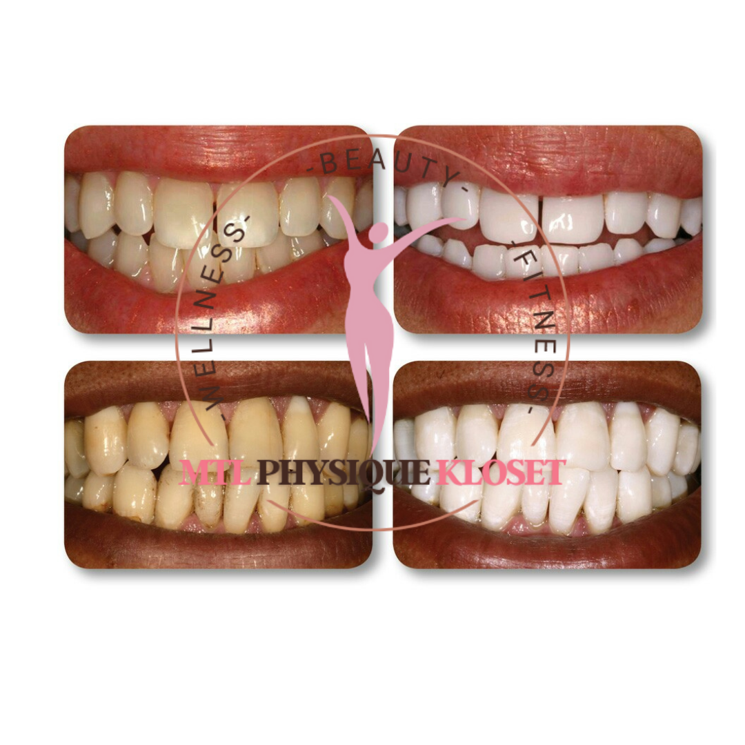 Ultra-Bright Teeth Whitening Essence (10ml) – Professional Enamel-Safe Stain Remover with Precision Cotton Applicators
