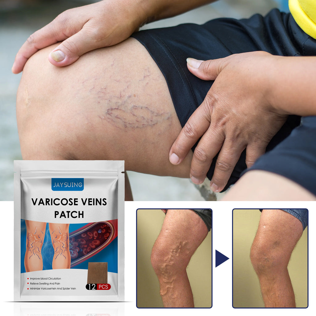 Vein Repair Patch To Relieve Pain And Swelling Earthworm Leg Blue Veins Repair Plaster