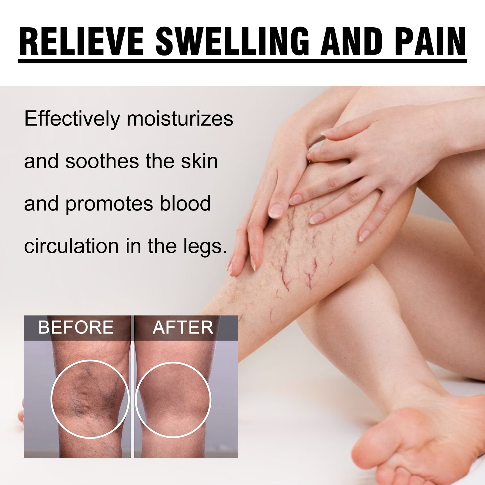 Veins Cream, Relieve The Pain And Discomfort Of Swollen Veins On The Legs