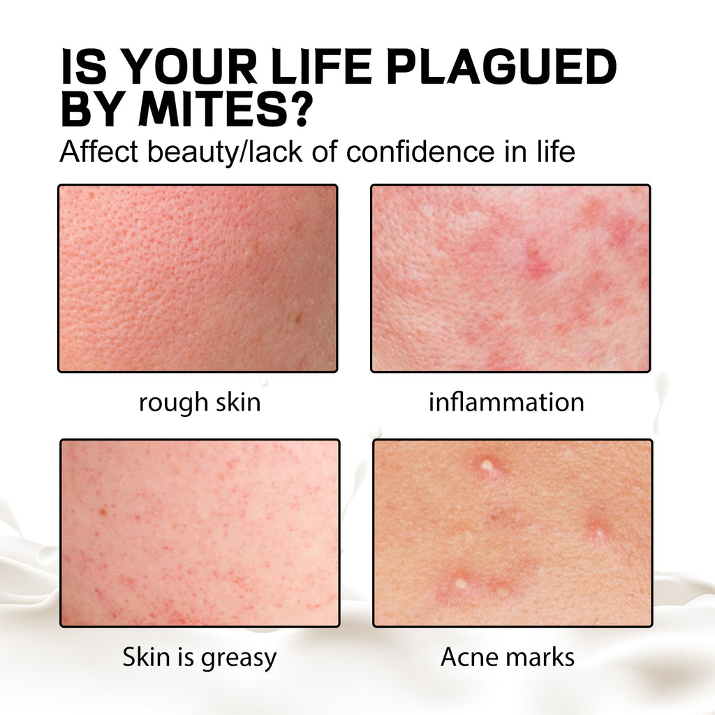 Aurora Purifying Mite-Removing Soap, Deep Cleansing Facial Body Skin Fade Acne Print Multi-Effect Cleansing Soap