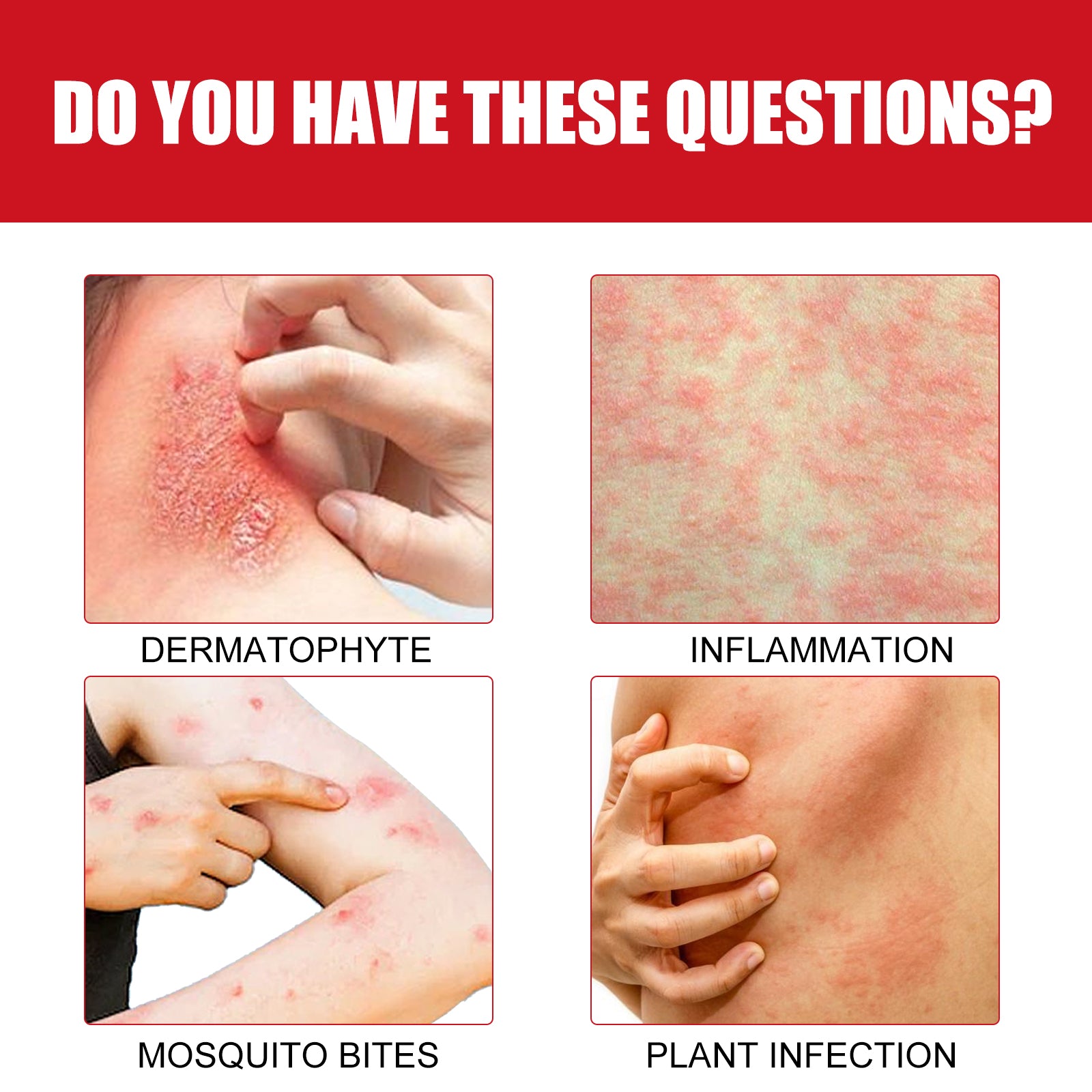 XiMonth Ultra Soothing Cream, Relieve Mosquito Bites Prickly Rash Skin Red And Itchy Skin Care Cream