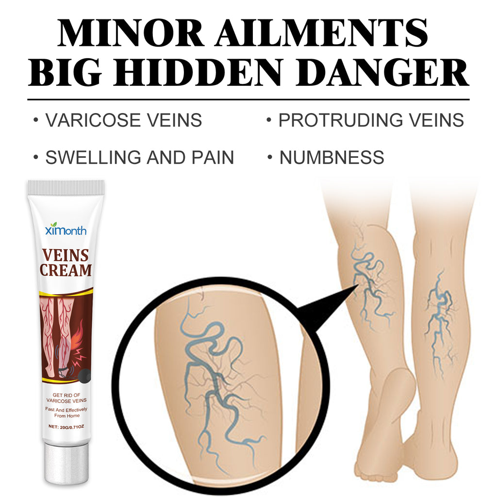 Veins Cream, Relieve The Pain And Discomfort Of Swollen Veins On The Legs