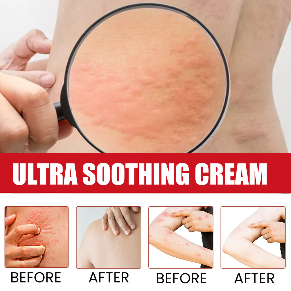 XiMonth Ultra Soothing Cream, Relieve Mosquito Bites Prickly Rash Skin Red And Itchy Skin Care Cream
